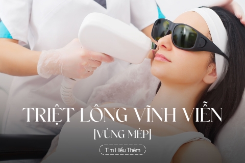 Triệt lông vùng mép vĩnh viễn